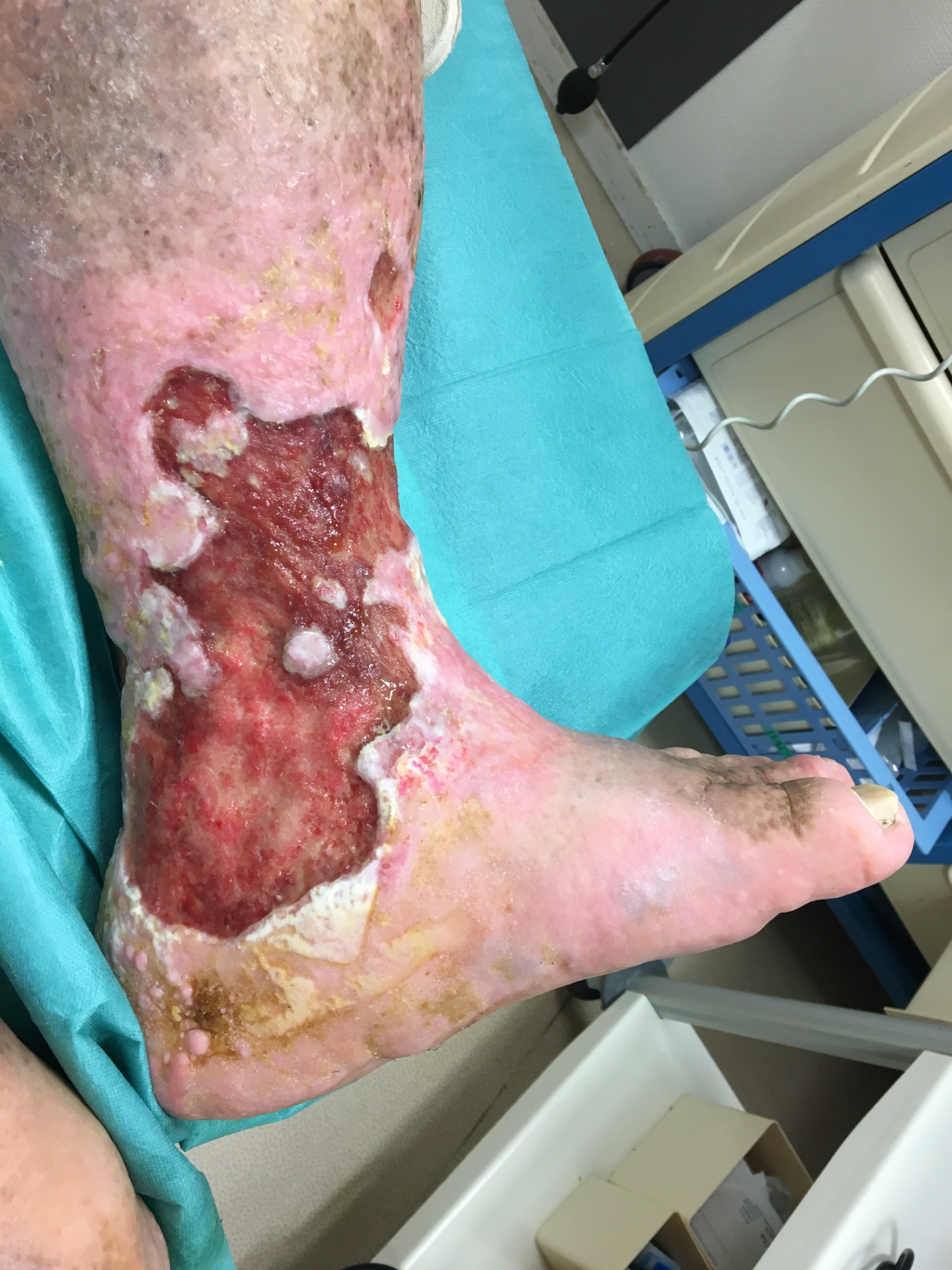 ulcere veineux extensif typique