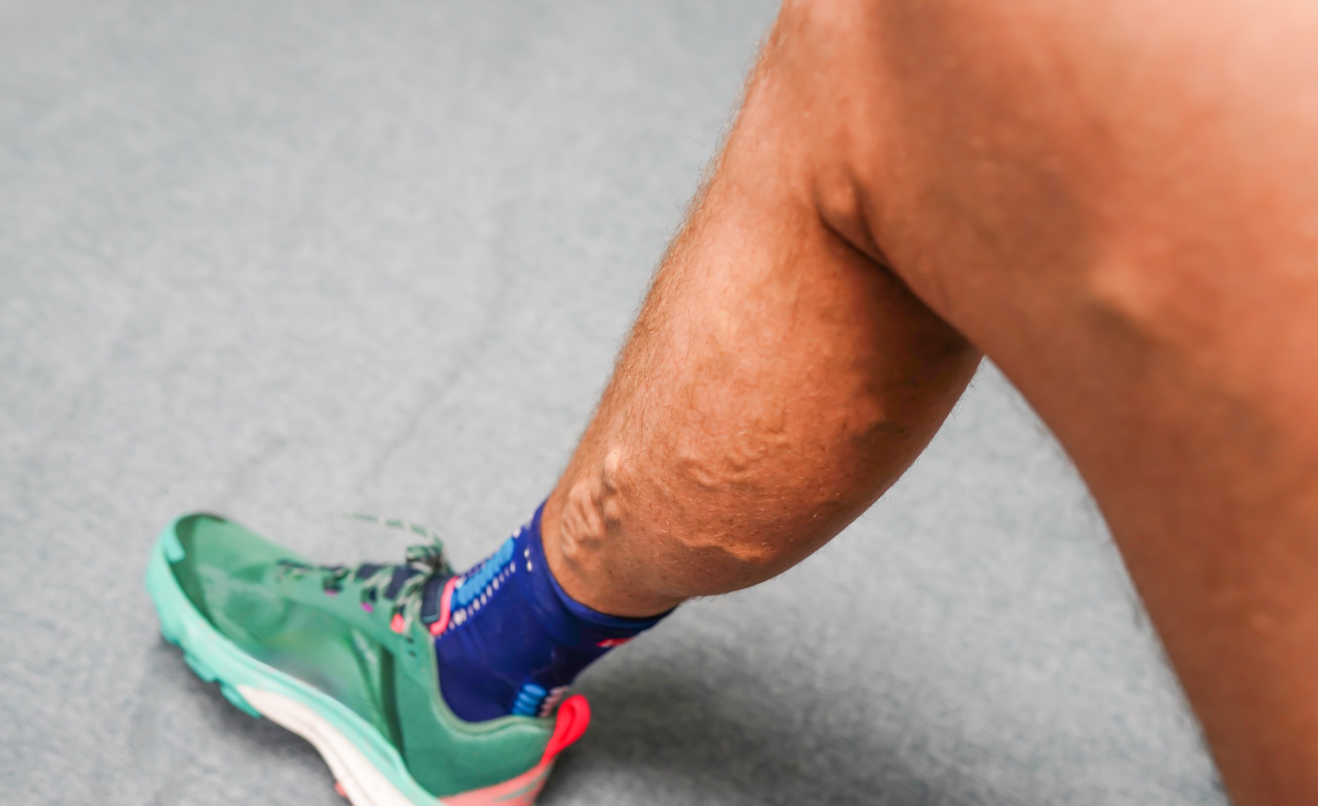 varices simples du membre inférieur