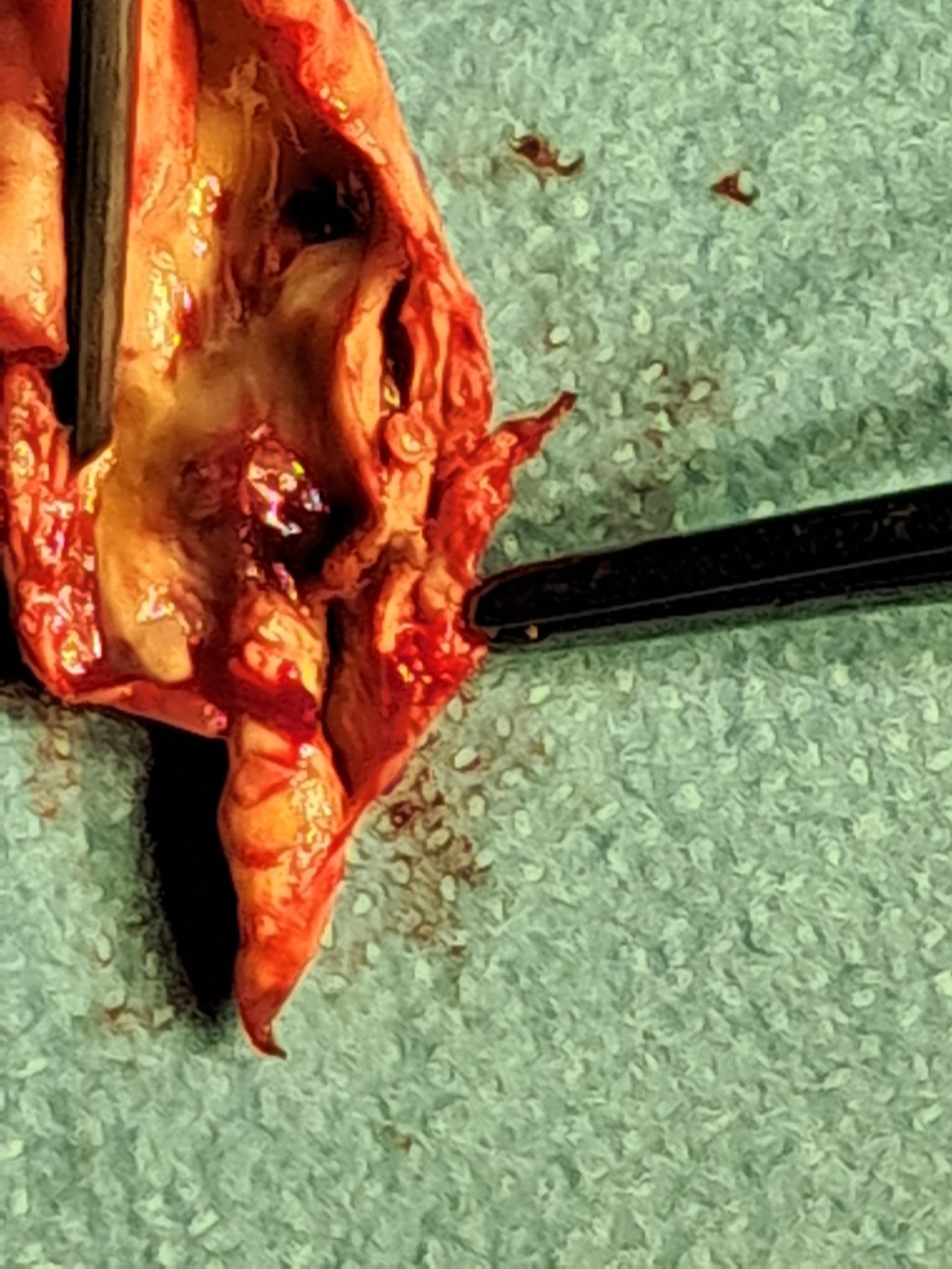 une plaque athéromateuse de la carotide (après endartériectomie par le Dr Guilhem Seban, chirurgien vasculaire, Annemasse)