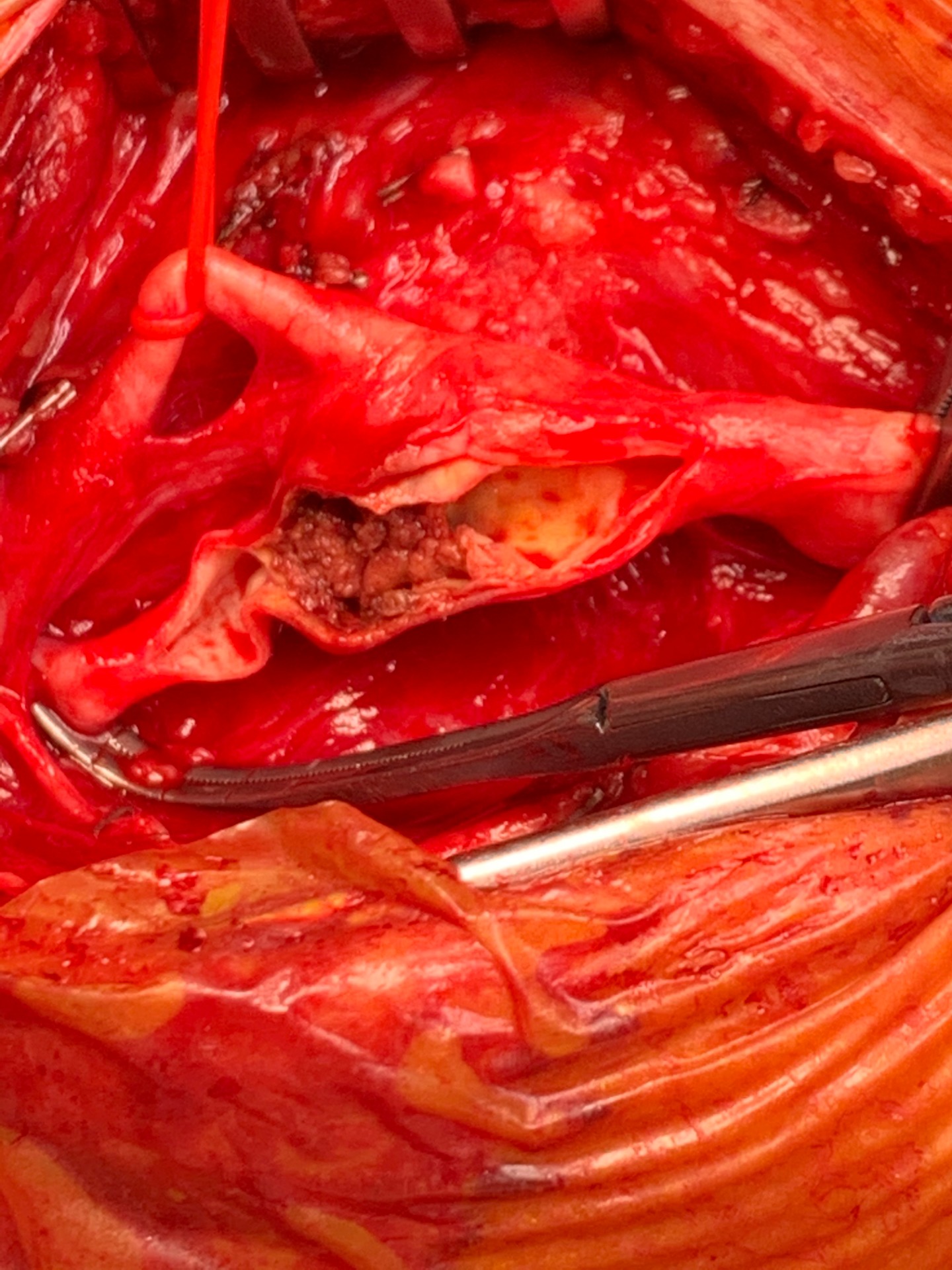 Vue opératoire d'une sténose athéromateuse de la carotide interne à haut potentiel emboligéne durant une intervention réalisée par le Dr Guilhem SEBAN, chirurgien vasculaire à Annemasse. 