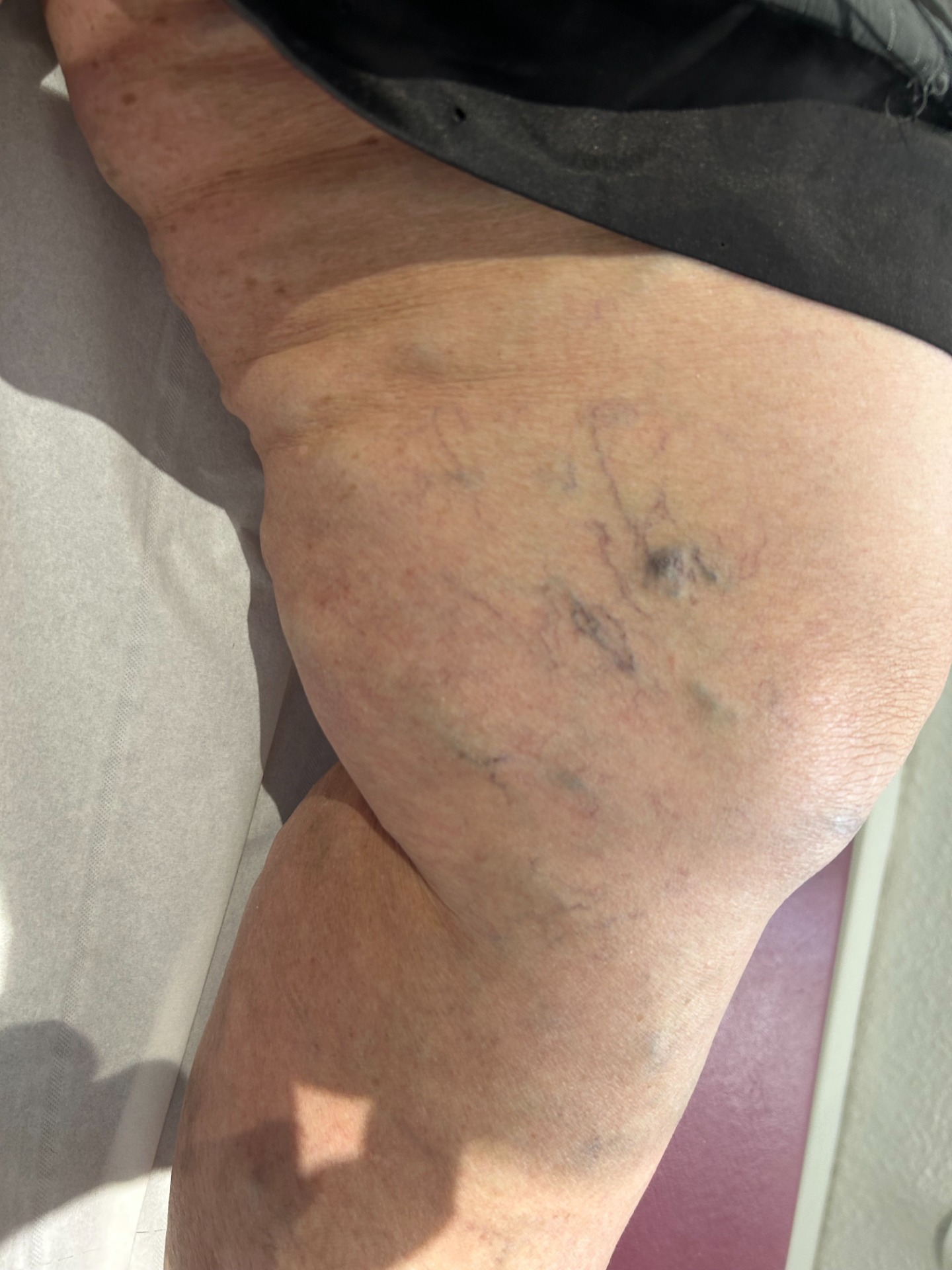 insuffisance veineuse avec veinules et telangiectasies. Dr Guilhem SEBAN